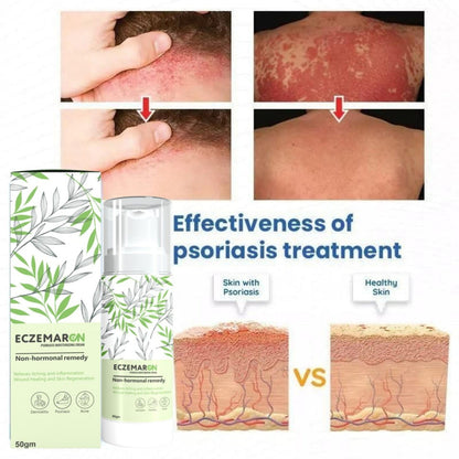 Eczemaron Cream (BUY 1 Get 1 FREE)